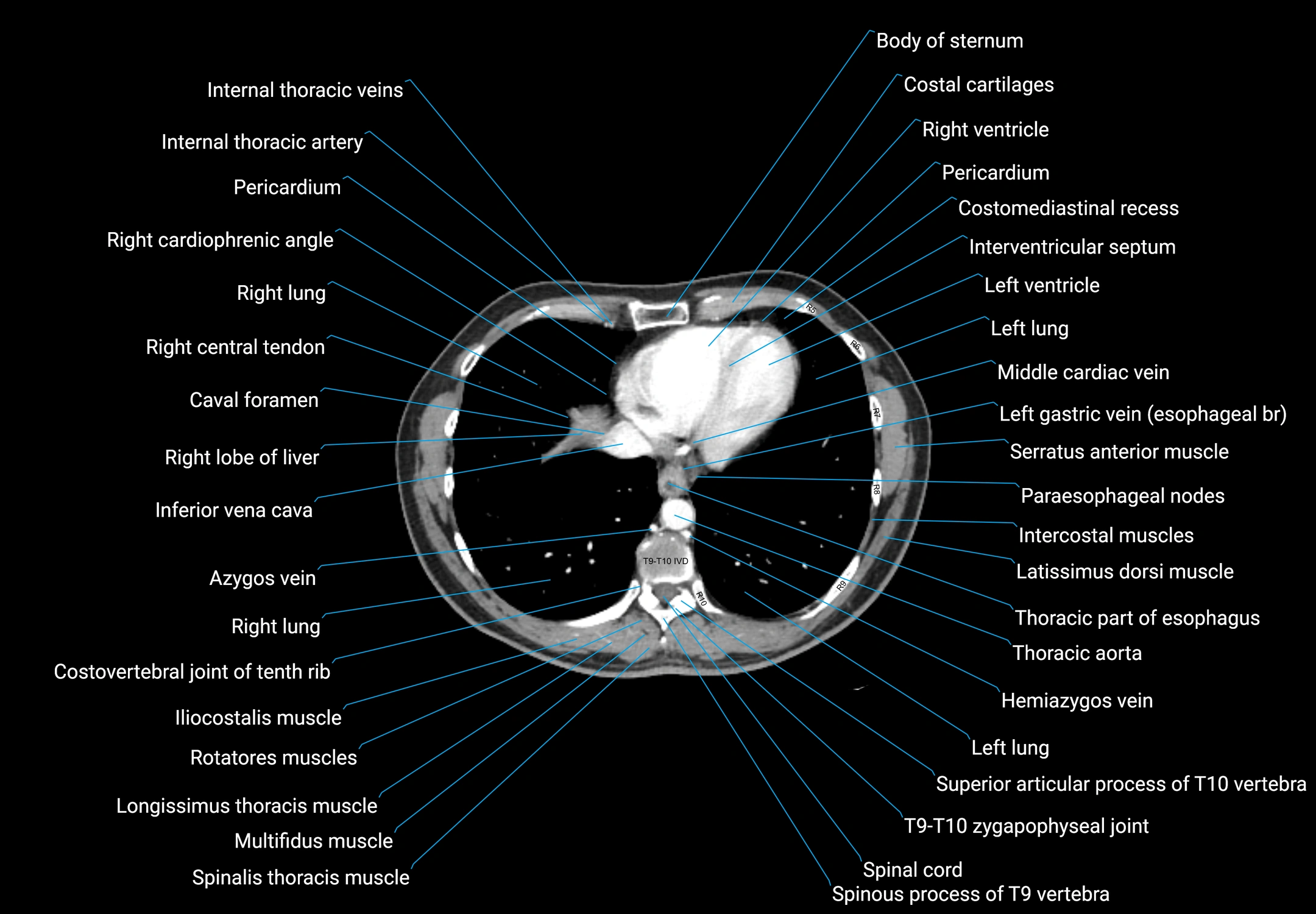 CT male pelvis axial cross sectional anatomy labelled radiology image -00008.webp